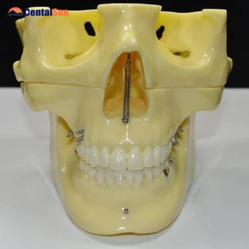 Ortodontijas Implantācija, Zobu Modeļa Demonstrācijas M2016